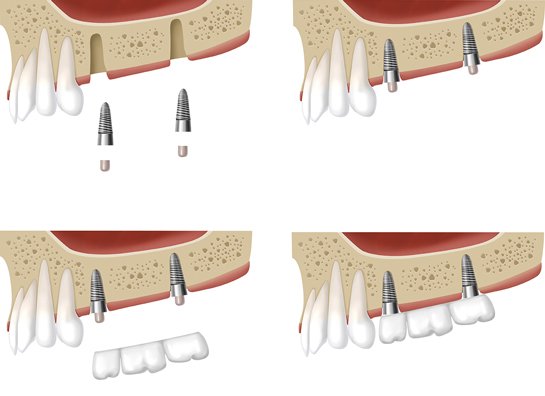 Implantologia dentale - Disegno impianto - Studio Dentistico Motta Jones Rossi & Associati - Milano Centro