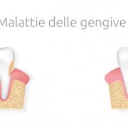 Malattie delle gengive: gengivite e parodontite -Studio Dentistico Motta Jones Rossi - Milano Centro
