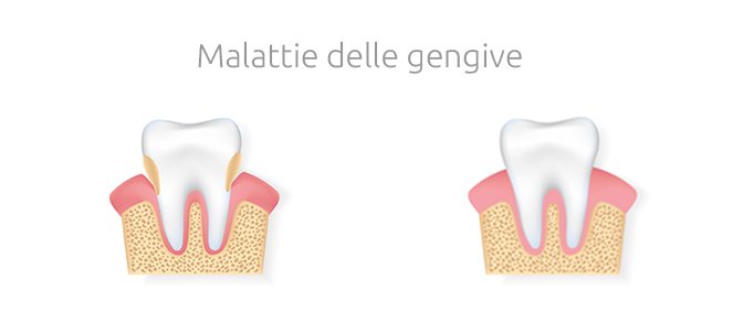 Malattie delle gengive: gengivite e parodontite -Studio Dentistico Motta Jones Rossi - Milano Centro