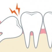 Denti del giudizio: cosa sono e come trattarli - Studio dentistico associato in centro a Milano