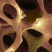 Osteonecrosi mandibolare e farmaci bifosfonati: dettaglio osso - Studio dentistico associato in centro a Milano