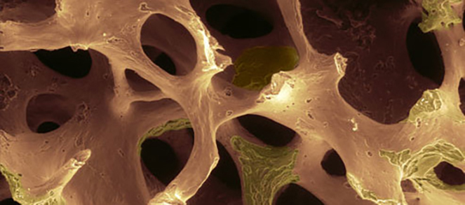 Osteonecrosi mandibolare e farmaci bifosfonati: dettaglio osso - Studio dentistico associato in centro a Milano