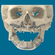 Studio Motta Jones - Rossi - Associati - impianti-dentali-stampati-3d- dentiera