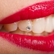 Brillantino al dente - Studio Dentistico Motta Jones, Rossi & Associati