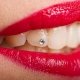 Brillantino al dente - Studio Dentistico Motta Jones, Rossi & Associati