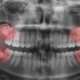 Estrazione dente del giudizio - Studio Dentistico Motta Jones, Rossi & Associati