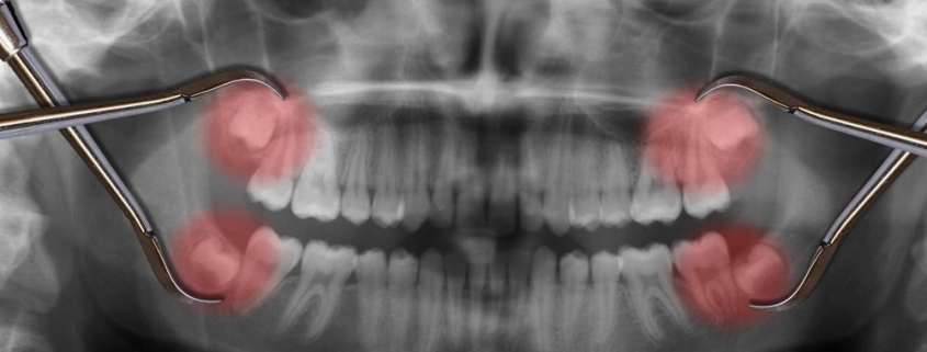 Estrazione dente del giudizio - Studio Dentistico Motta Jones, Rossi & Associati