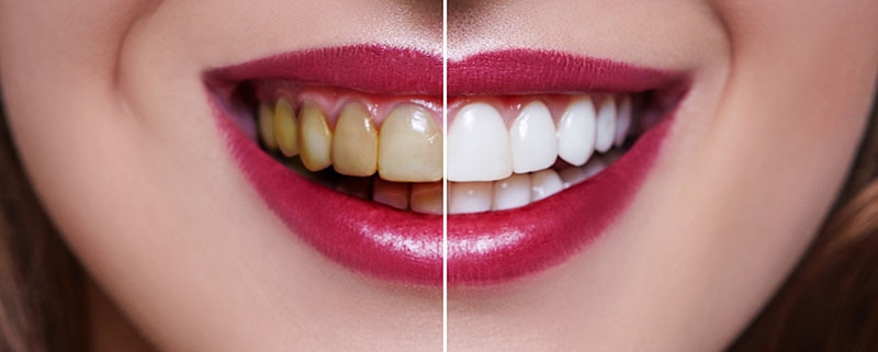 faccette dentali