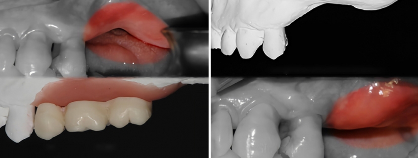 Chirurgia ossea ricostruttiva 3D - Studio Dentistico Motta Jones Rossi & Associati - Milano Centro