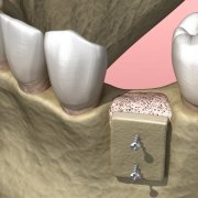 Autotrapianto dentale, quando è efficace?