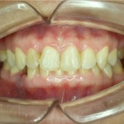 ortodonzia-invisibile-morso-profondo - Studio Motta Jones, Rossi & Associati