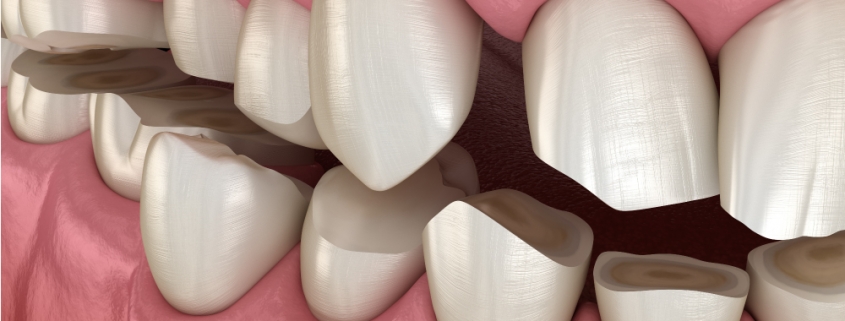 denti consumati - Studio dentistico Motta Jones, Rossi & Associati