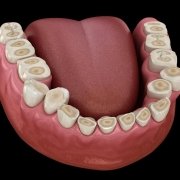 Erosione dentale da reflusso gastro esofageo - Studio Motta Jones, Rossi & Associati
