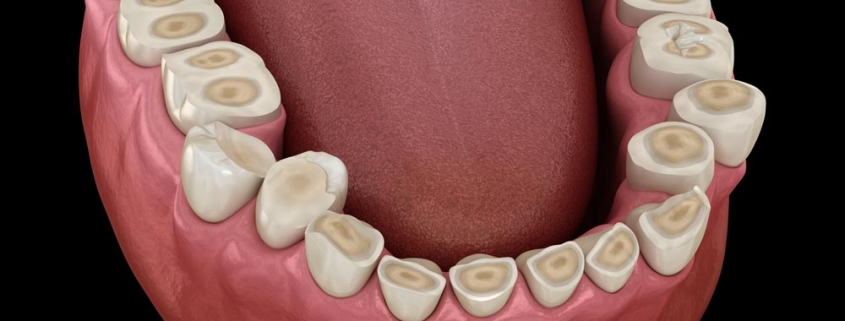 Erosione dentale da reflusso gastro esofageo - Studio Motta Jones, Rossi & Associati