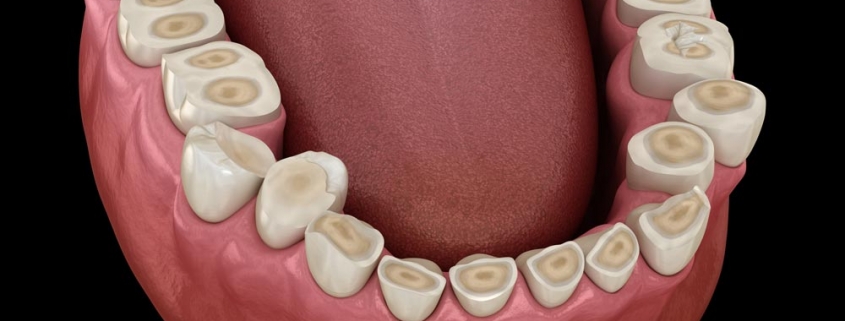 erosione-dentale-da-reflusso-gastroesofageo Erosione dentale da reflusso gastro esofageo - Studio Motta Jones, Rossi & Associati