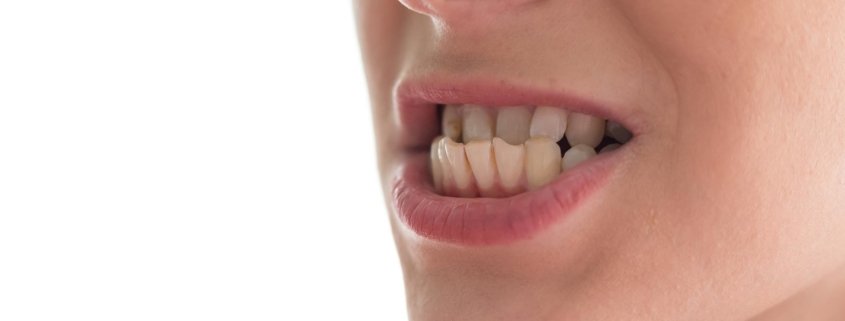 limare-i-denti-2