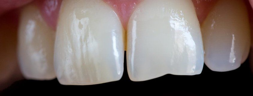 limare-i-denti-3