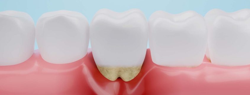 parodontite-cura-risolutiva