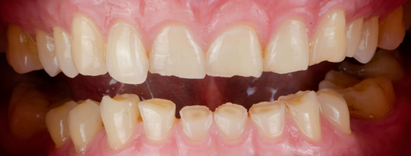 denti-consumati-4