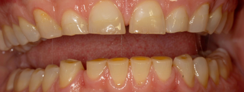 denti-consumati-6