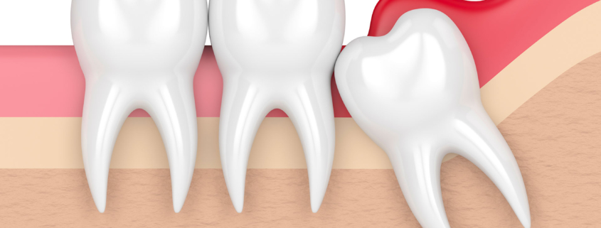 pericoronite-dente-giudizio