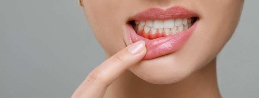 Periodontitis and oral cavity cancer